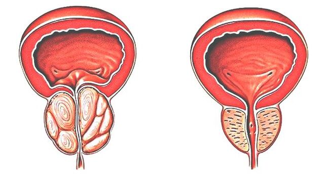 Prostatitis y próstata normal. 