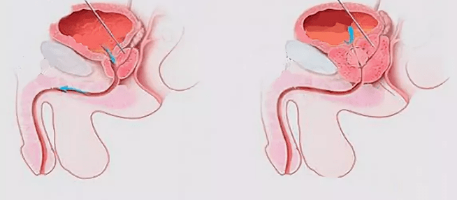 Signos de prostatitis en hombres