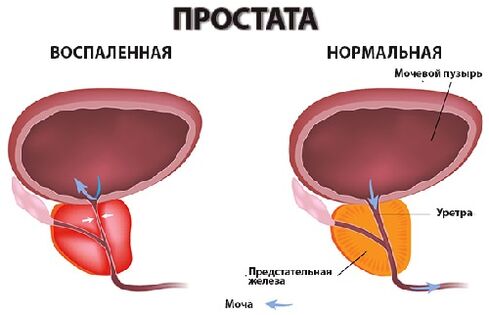 próstata