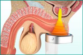 Tratamiento de la prostatitis