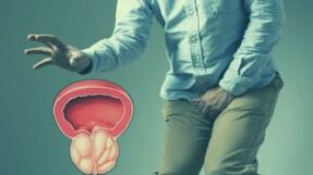 Prostatitis aguda