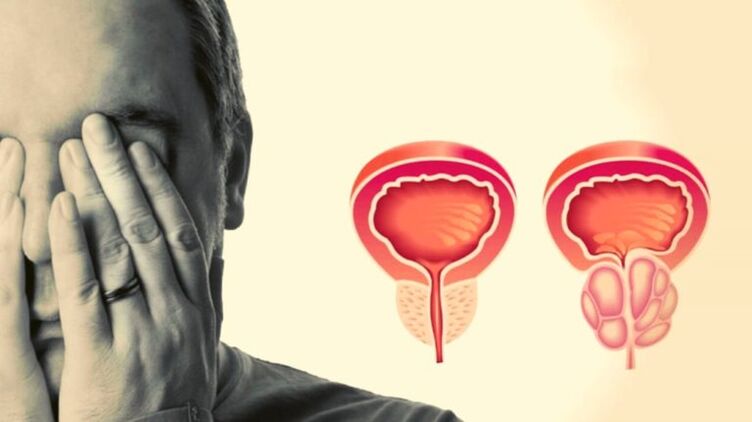 Un hombre tiene prostatitis