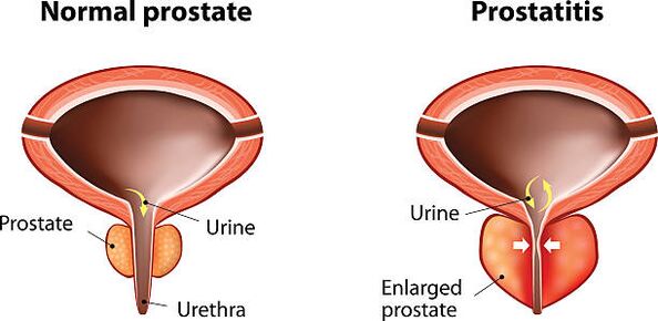 próstata normal e inflamada
