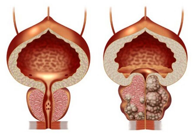 próstata sana y adenoma de próstata